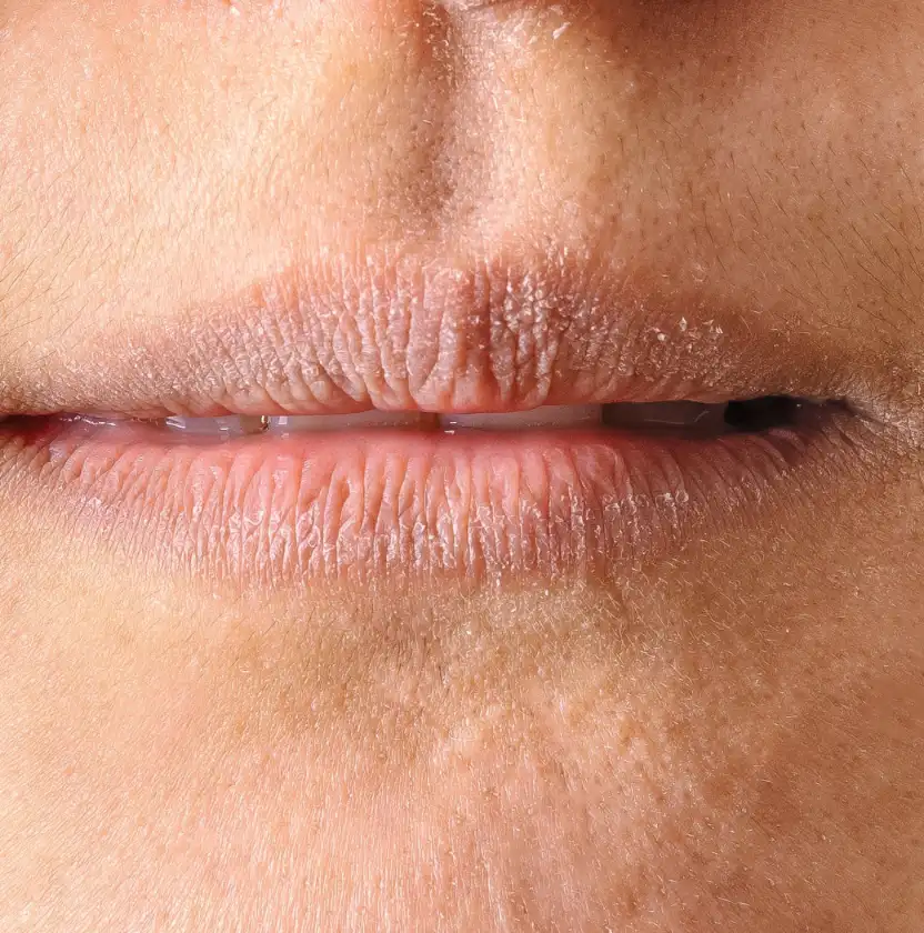 Nahaufnahme von ausgetrockneten Lippen